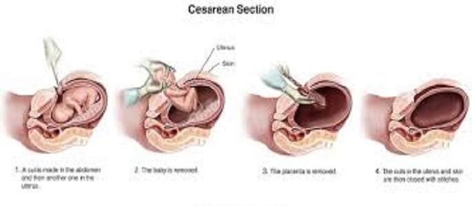 C-Section Part1